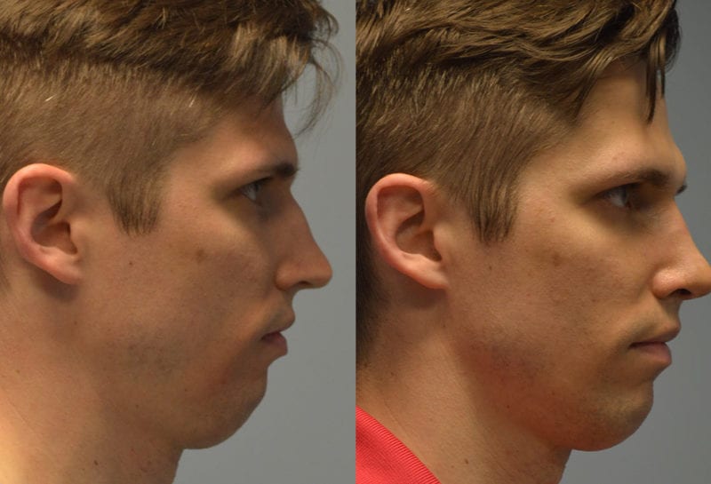 Nose reshaping results at Maningas Cosmetic Surgery in Joplin, MO and Northwest Arkansas