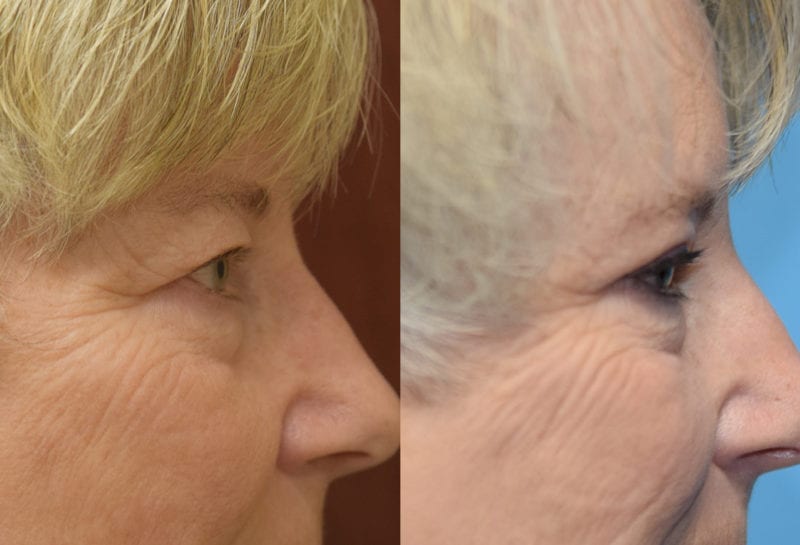 Eyelid surgery results at Maningas Cosmetic Surgery in Joplin, MO and Northwest Arkansas