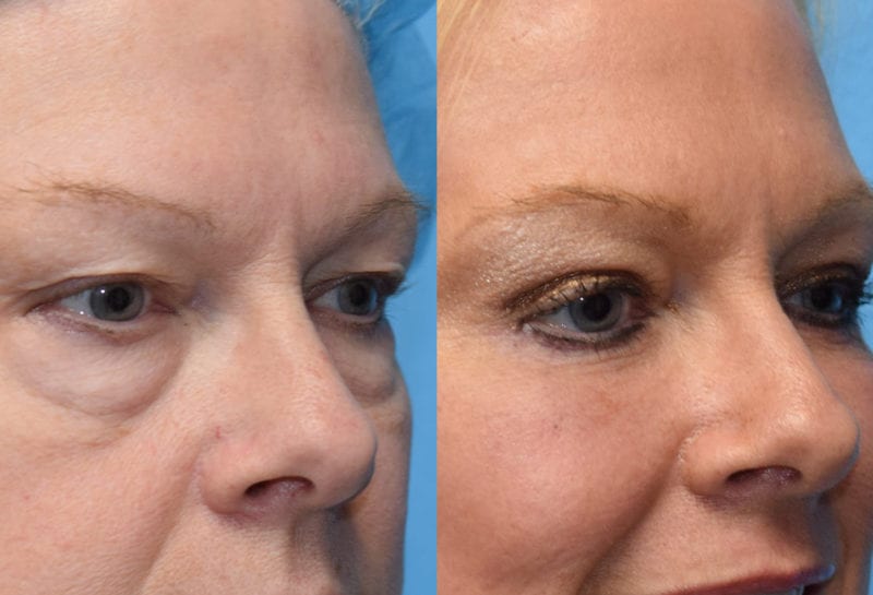 Lower Lid Results from Maningas Cosmetic Surgery in Joplin, MO and Northwest Arkansas