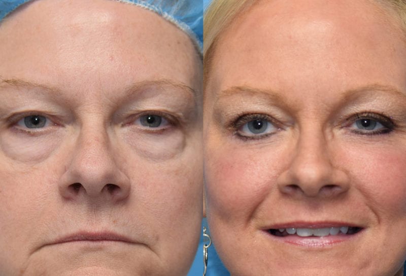 Eyelid Surgery results at Maningas Cosmetic Surgery in Joplin, MO and Northwest Arkansas