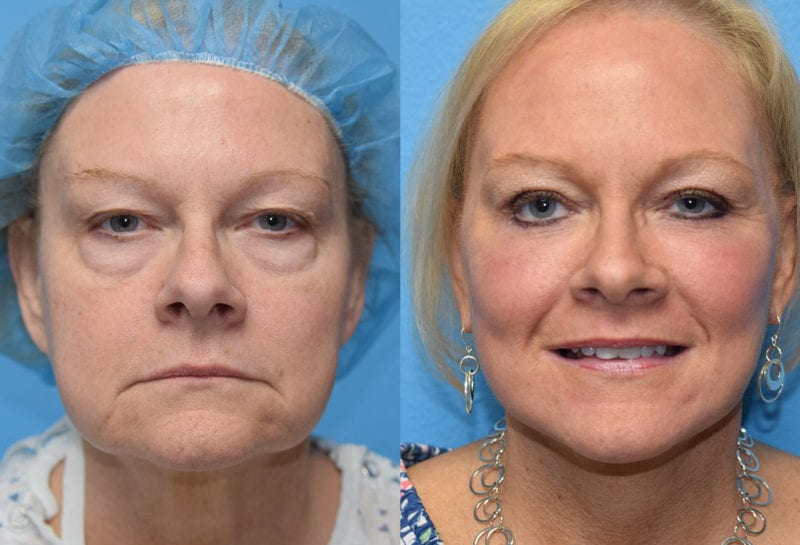 Facelift results at Maningas Cosmetic Surgery in Joplin, MO and Northwest Arkansas