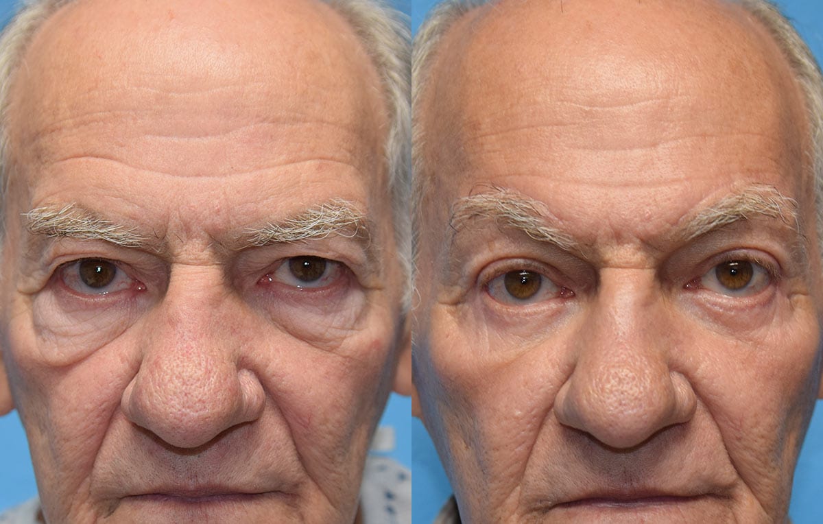 Eyelid surgery results at Maningas Cosmetic Surgery in Joplin, MO and Northwest Arkansas
