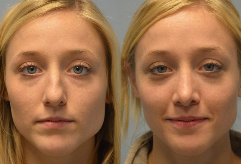 Nose reshaping results at Maningas Cosmetic Surgery in Joplin, MO and Northwest Arkansas