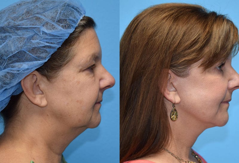 Facelift results at Maningas Cosmetic Surgery in Joplin, MO and Northwest Arkansas