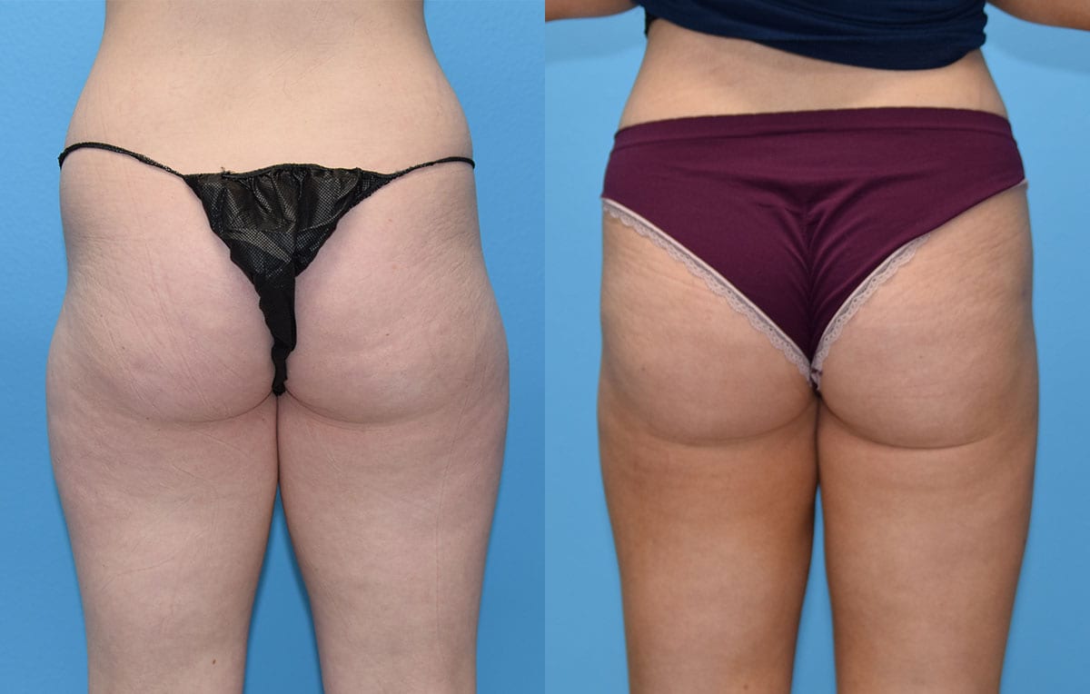 Liposuction of the inner and outer thighs with fat transfer to hip-dips at Maningas Cosmetic Surgery in Joplin, MO