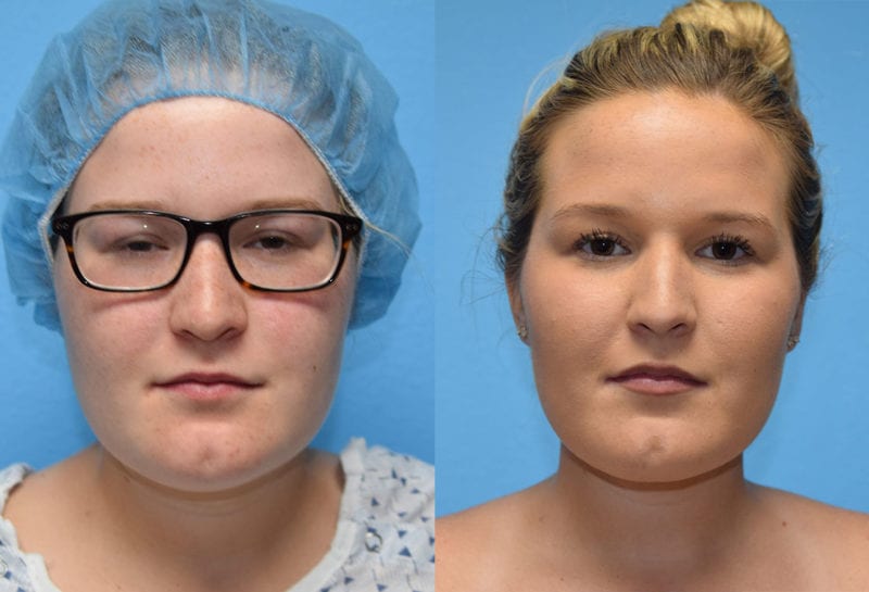 Liposuction for facial contouring of the neck and jaw at Maningas Cosmetic Surgery in Joplin, MO