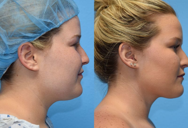 Liposuction for facial contouring of the neck and jaw at Maningas Cosmetic Surgery in Joplin, MO