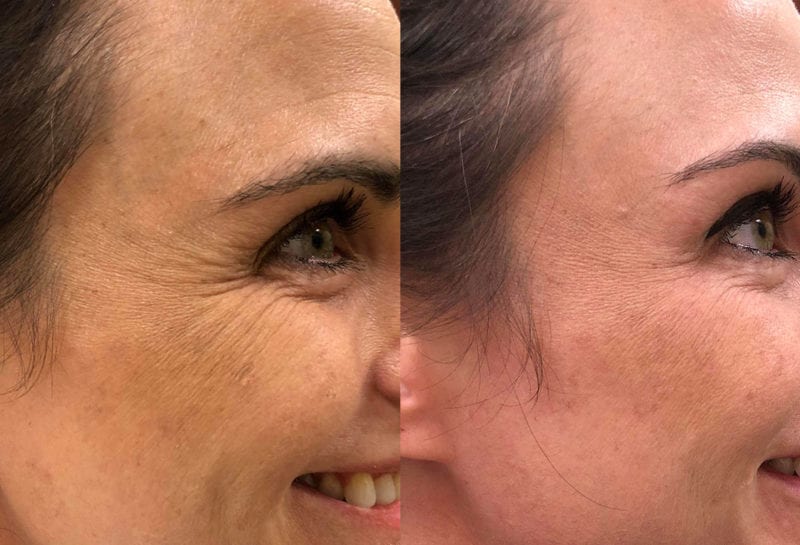 Botox Results in Joplin at Maningas Cosmetic Surgery by Nurse Beth