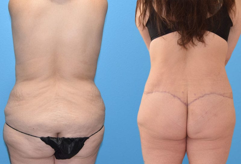 Body Lift results by Dr. Maningas at Maningas Cosmetic Surgery in Joplin, MO