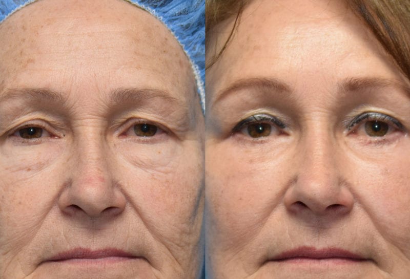 Eyelid and Brow Lift surgery results at Maningas Cosmetic Surgery in Joplin, MO and Northwest Arkansas