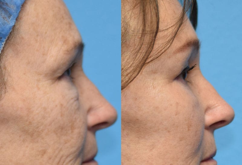 Eyelid and Brow Lift results at Maningas Cosmetic Surgery in Joplin, MO and Northwest Arkansas