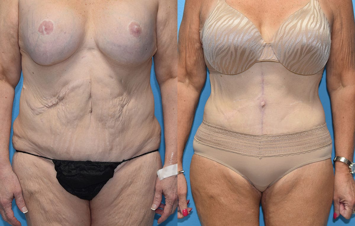 Fleur-de-lis Tummy tuck results by Dr. Maningas at Maningas Cosmetic Surgery in Joplin, MO