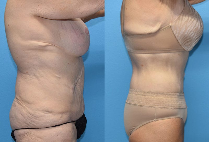 fleur-de-lis Tummy tuck results by Dr. Maningas at Maningas Cosmetic Surgery in Joplin, MO