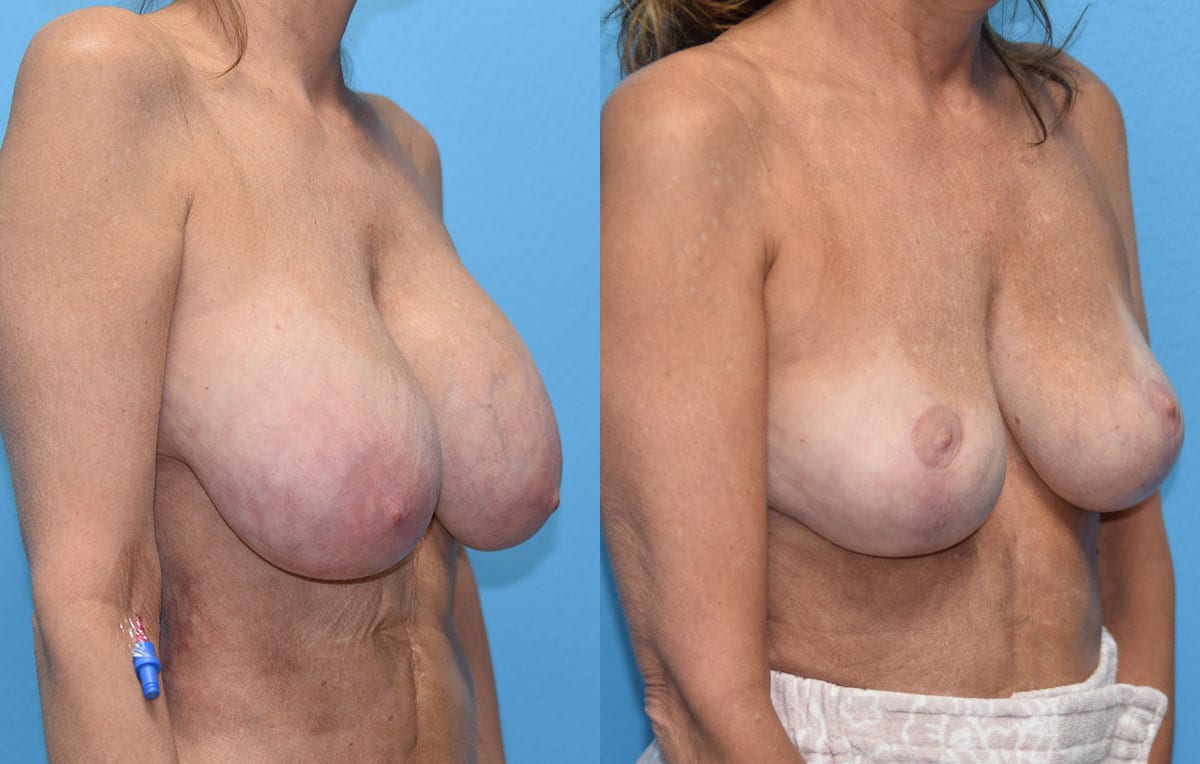 Cosmetic breast revision results by Dr. Maningas at Maningas Cosmetic Surgery in Missouri and Arkansas