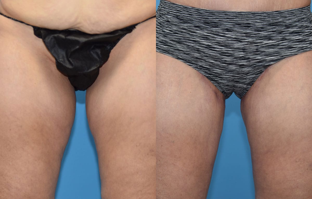 Inner Thigh Lift by Dr. Maningas at Maningas Cosmetic Surgery in Joplin, MO