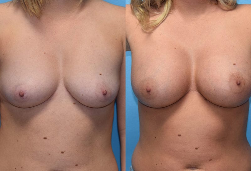 breast augmentation results by dr. maningas at maningas cosmetic surgery in joplin, mo