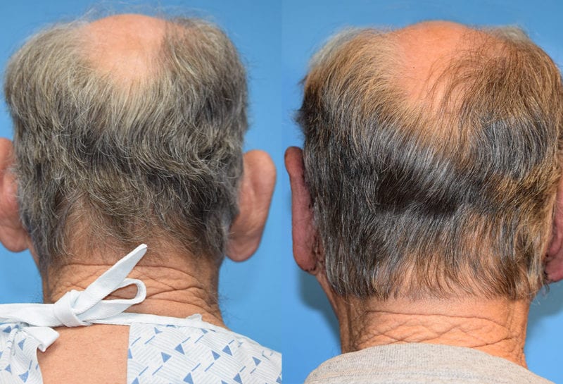 ear reshaping-otoplasty-maningas cosmetic surgery-joplin,mo