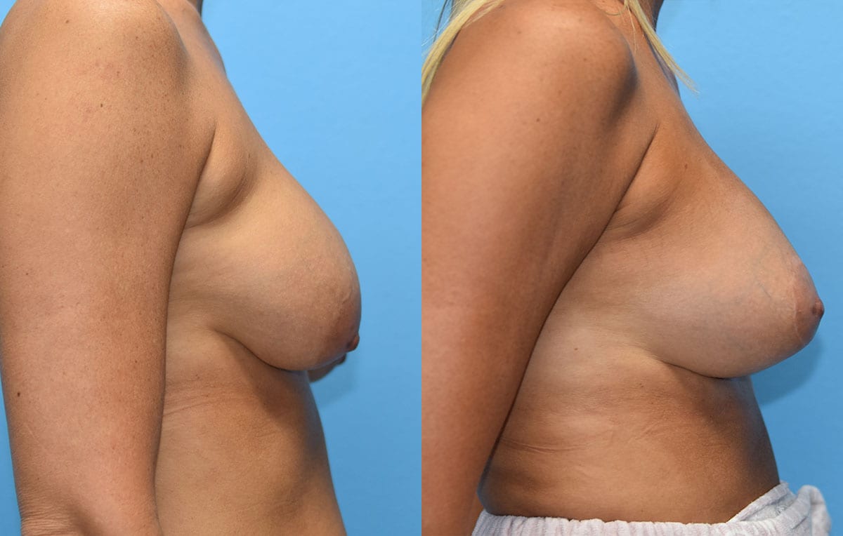 Cosmetic breast revision results by Dr. Maningas at Maningas Cosmetic Surgery in Missouri and Arkansas