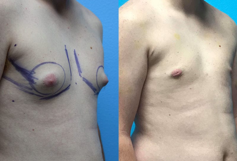 Gynecomastia Repair, or Male Breast Reduction, results by Dr. Maningas at Maningas Cosmetic Surgery in Joplin, MO and Northwest Arkansas