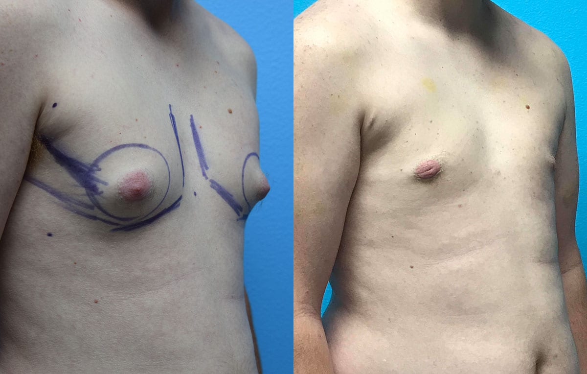 Gynecomastia Repair, or Male Breast Reduction, results by Dr. Maningas at Maningas Cosmetic Surgery in Joplin, MO and Northwest Arkansas