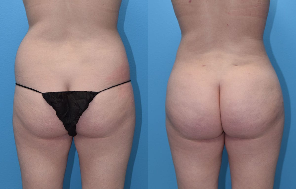 Brazilian Butt Lift by Dr. Maningas at Maningas Cosmetic Surgery in Joplin, MO
