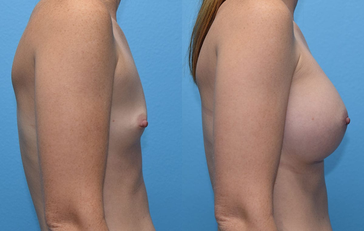 breast augmentation results by dr. maningas at maningas cosmetic surgery in joplin, mo
