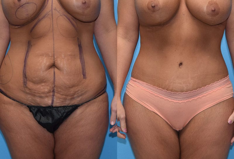 Tummy tuck results by Dr. Maningas at Maningas Cosmetic Surgery in Joplin, MO