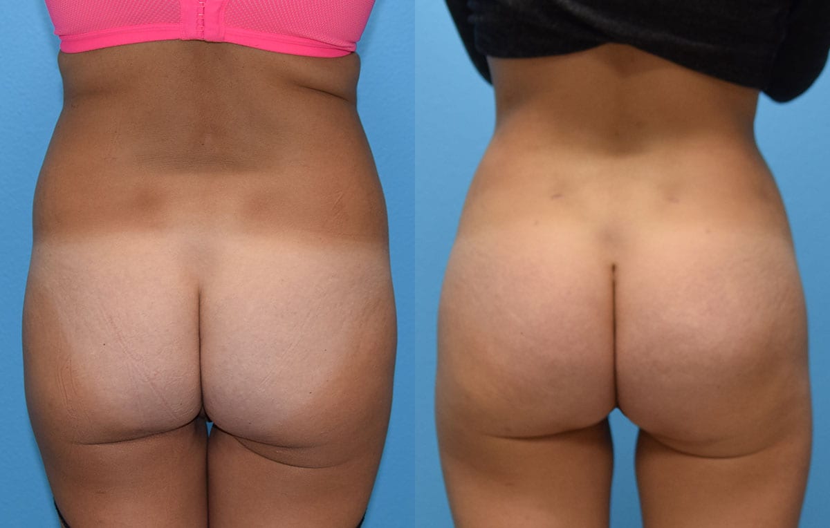 Brazilian Butt Lift by Dr. Maningas at Maningas Cosmetic Surgery in Joplin, MO