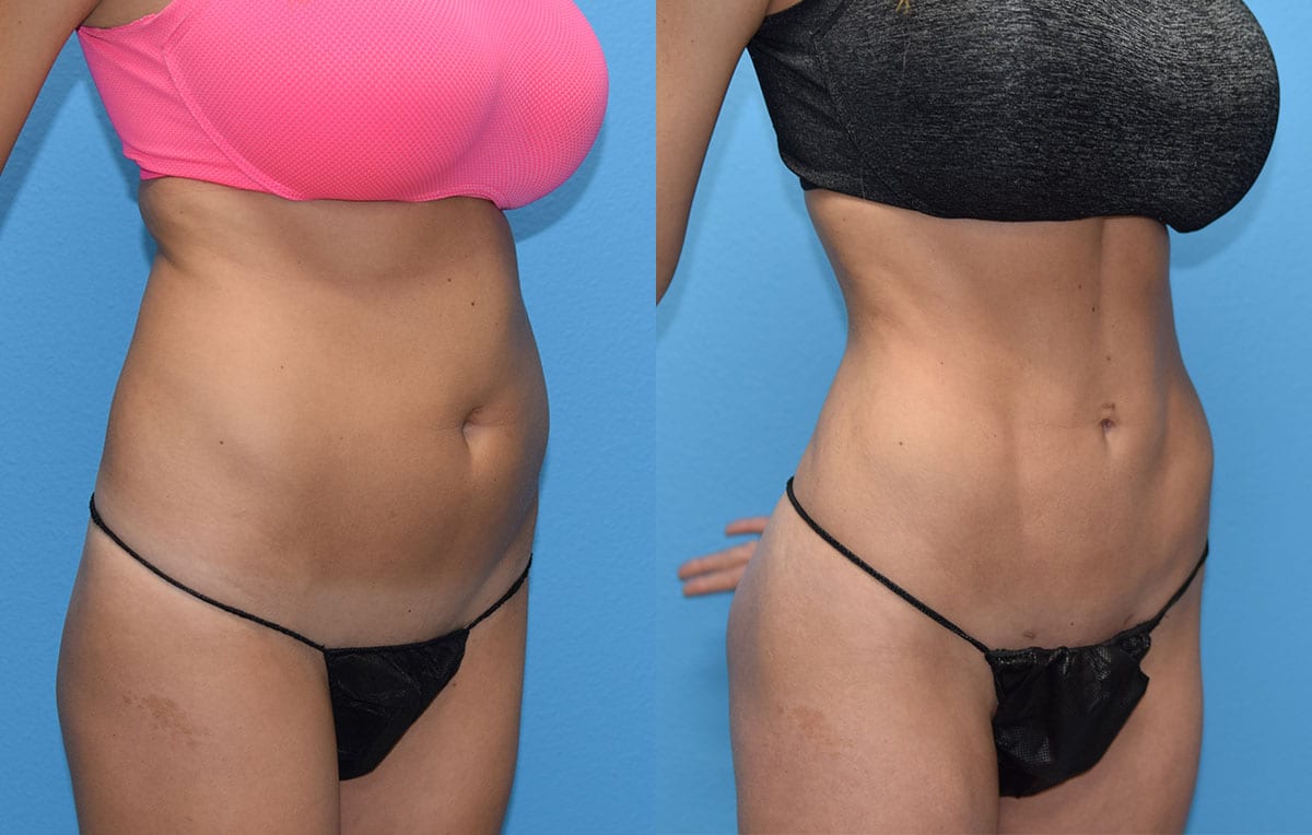 Liposuction Results by Dr. Maningas at Maningas Cosmetic Surgery in Joplin, MO