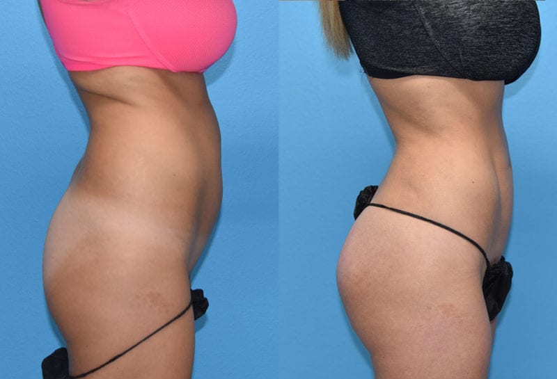 Liposuction Results by Dr. Maningas at Maningas Cosmetic Surgery in Joplin, MO