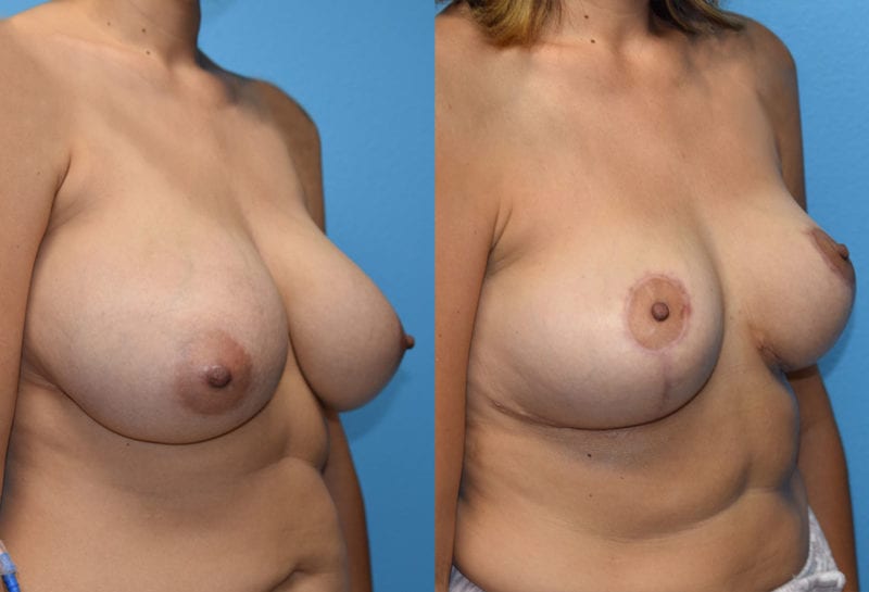 breast reduction results by Dr. Maningas as Maningas Cosmetic Surgery