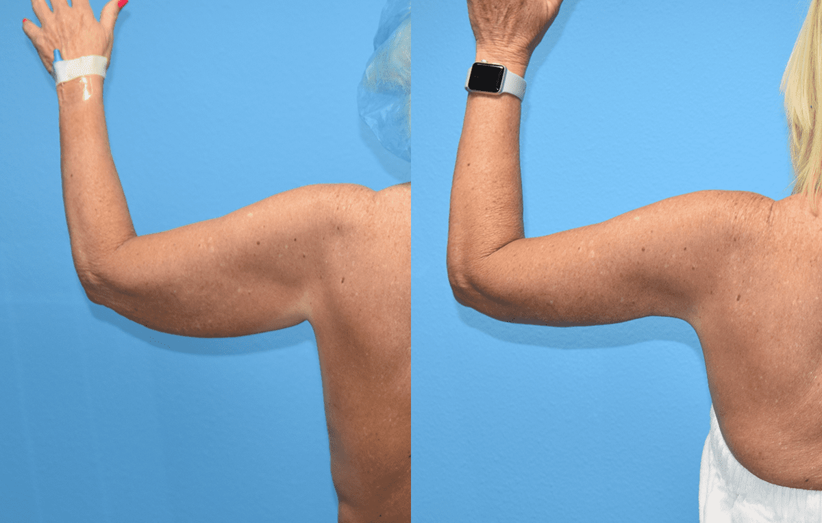 Arm Lift results by Dr. Maningas at Maningas Cosmetic Surgery in Joplin, MO