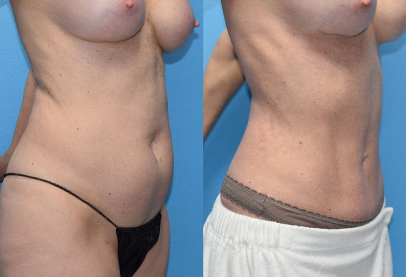 Mini Tummy Tuck results by Dr. Maningas at Maningas Cosmetic Surgery in Joplin, MO and Northwest Arkansas.