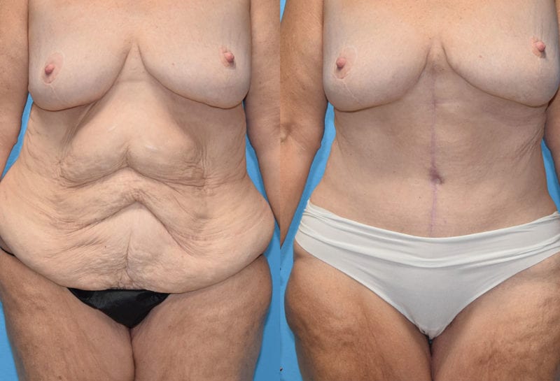 Fleur-de-lis Tummy tuck results by Dr. Maningas at Maningas Cosmetic Surgery in Joplin, MO