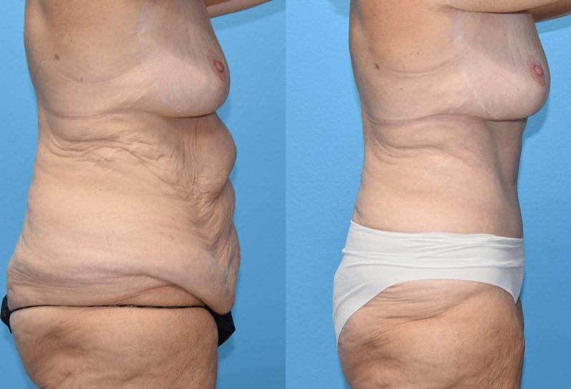 Fleur-de-Lis Tummy tuck results by Dr. Maningas at Maningas Cosmetic Surgery in Joplin, MO