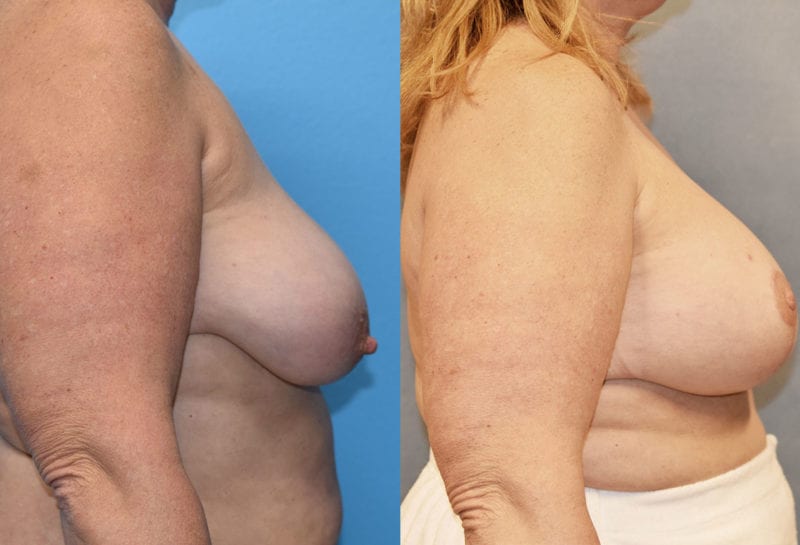 Breast Lift with Implant results by Dr. Maningas at Maningas Cosmetic Surgery in Missouri and Arkansas