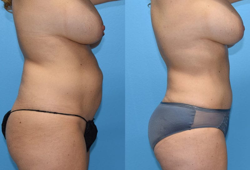 Tummy tuck results by Dr. Maningas at Maningas Cosmetic Surgery in Joplin, MO
