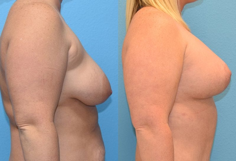 Breast Lift with Implant results by Dr. Maningas at Maningas Cosmetic Surgery in Missouri and Arkansas