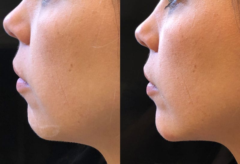 Chin filler results at Maningas Cosmetic Surgery in Joplin, MO