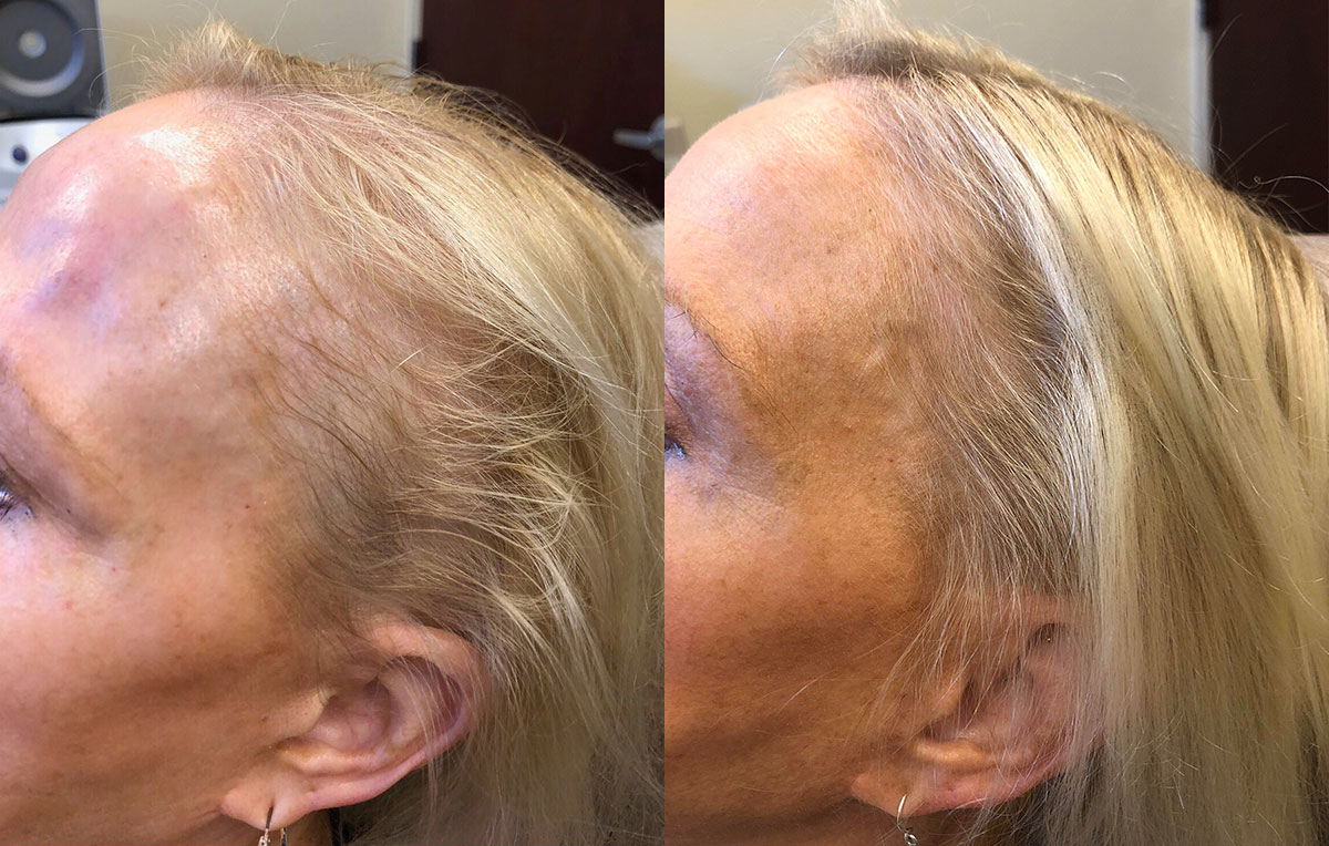 PRP injections for hair loss at Maningas Cosmetic Surgery in Joplin, MO