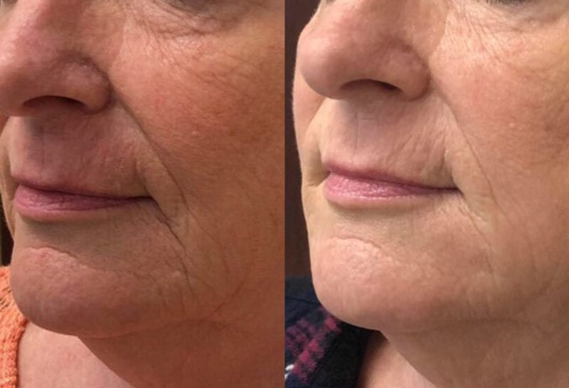 Lower Mouth Filler Results at Maningas Cosmetic Surgery in Joplin, MO