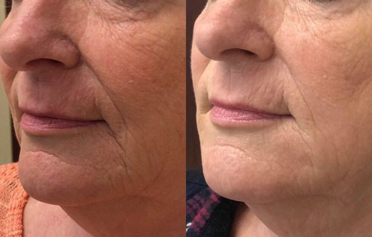 Lower Mouth Filler Results at Maningas Cosmetic Surgery in Joplin, MO