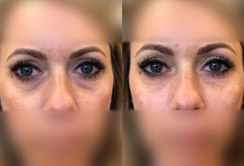 Tear Trough, Lower Lid, Filler Results at Maningas Cosmetic Surgery in Joplin, MO