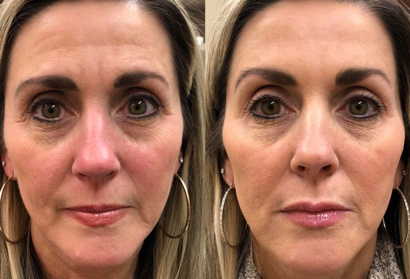 Non-Surgical Liquid facelift results at Maningas Cosmetic Surgery in Joplin, MO
