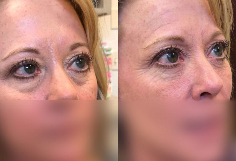 Tear Trough, Lower Lid, Filler Results at Maningas Cosmetic Surgery in Joplin, MO