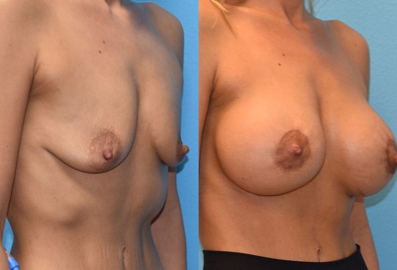 Benelli Breast Lift with Implant results by Dr. Maningas at Maningas Cosmetic Surgery in Missouri and Arkansas