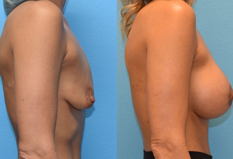 Benelli Breast Lift with Implant results by Dr. Maningas at Maningas Cosmetic Surgery in Missouri and Arkansas
