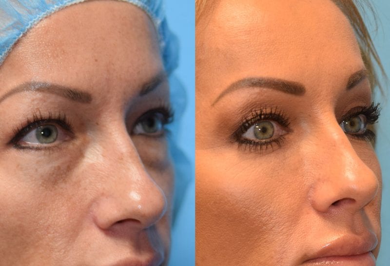 Lower eyelid surgery to remove under eye bags at Maningas Cosmetic Surgery in Joplin, MO and Northwest Arkansas