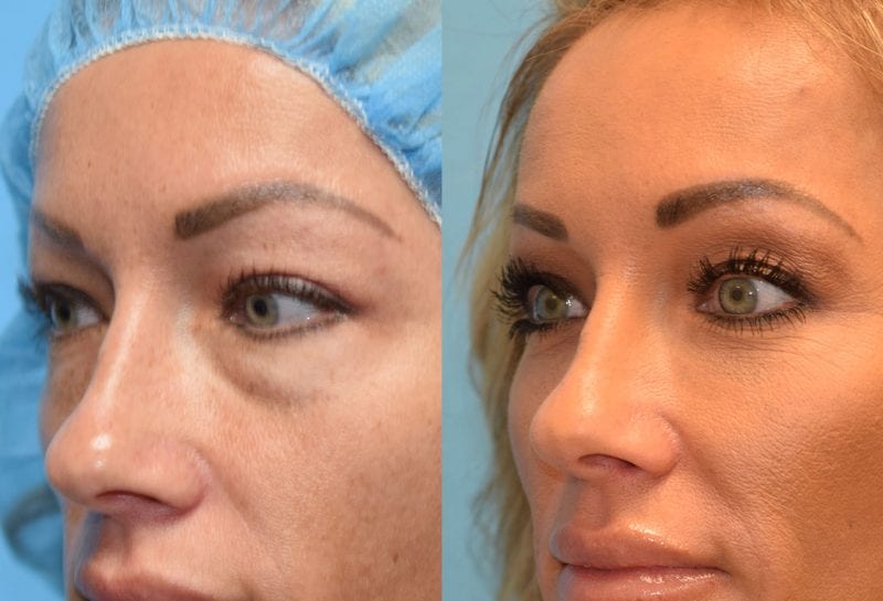 Lower eyelid surgery to remove under eye bags at Maningas Cosmetic Surgery in Joplin, MO and Northwest Arkansas