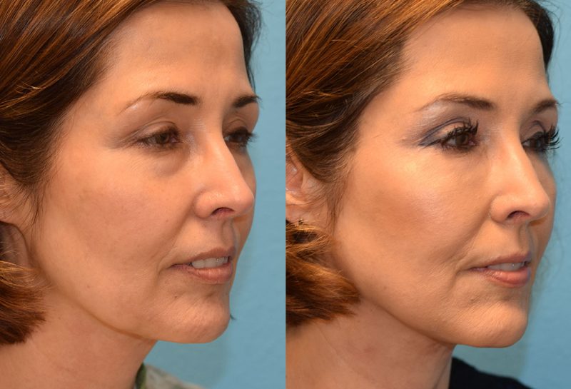 Facetite and Morpheus8, aka EmbraceRF, 4 month results at Maningas Cosmetic Surgery in Joplin, MO.